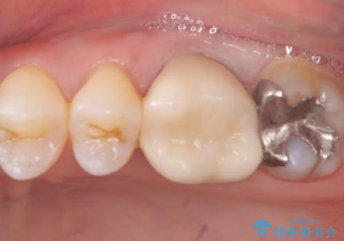 【セラミックインレー】口の中から金属を無くしたい