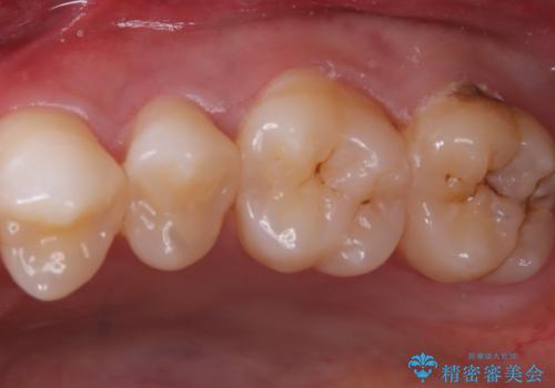 【セラミックインレー】歯科検診で虫歯が見つかったの症例 治療前