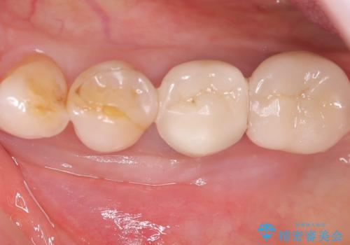 【セラミッククラウン】知覚過敏をどうにかしてほしいの症例 治療前