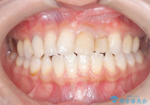 【セラミッククラウン】歯の根元が欠けた、歯が揺れている気がするの症例 治療前