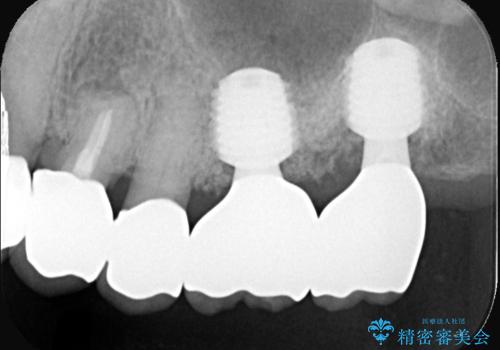 難症例の奥歯も3ヶ月で機能回復!抜歯即時インプラントでスピード解決の症例 治療後