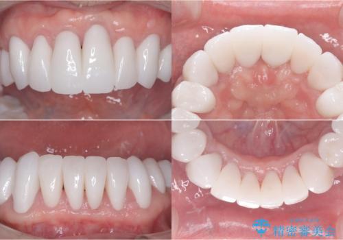 歯がボロボロで咬合崩壊 矯正・インプラント・セラミックで実現する、酸蝕症の総合治療の治療後