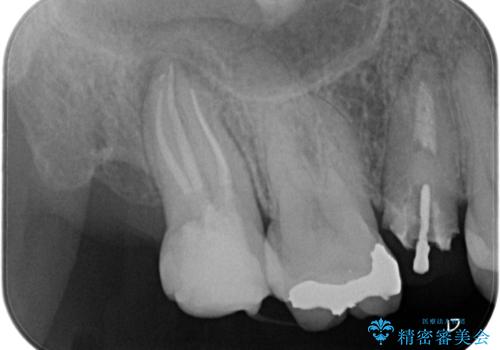 奥歯の根の病変も精密治療で解決の治療後