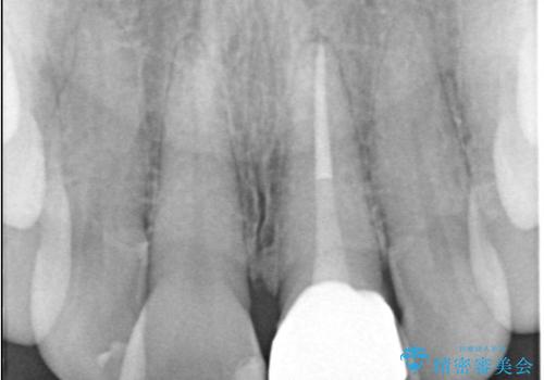 前歯の変色を改善し、本来の自然な美しさへの治療後