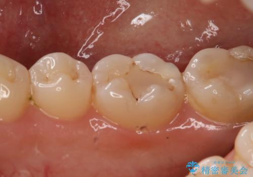 奥歯の虫歯を直したい セラミックインレーの治療前