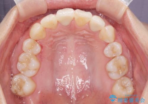 がたつきと出っ歯 ワイヤー矯正での歯並び改善の治療後