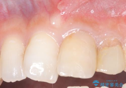 【セラミッククラウン】歯の根元が欠けた、歯が揺れている気がするの治療前