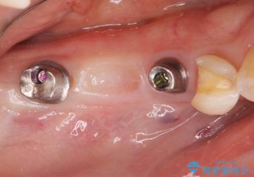 失った奥歯をインプラントで機能回復の治療中