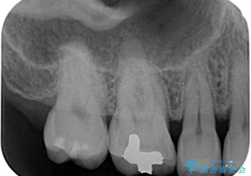 舌で触ると段差が気になる ゴールドインレー修復の治療前