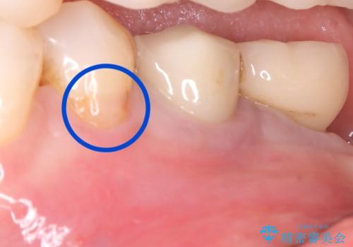 【セラミッククラウン】知覚過敏をどうにかしてほしいの治療前