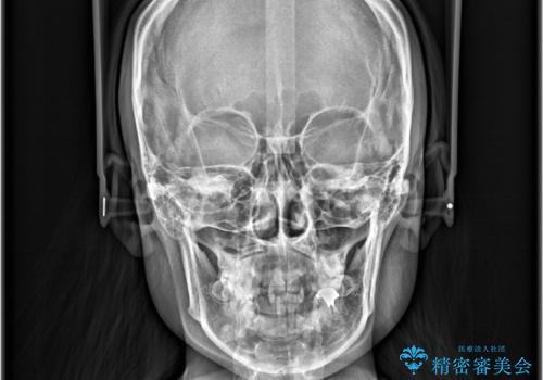 歯のデコボコ|口ボコ|八重歯が気になる!|ワイヤー矯正の治療前