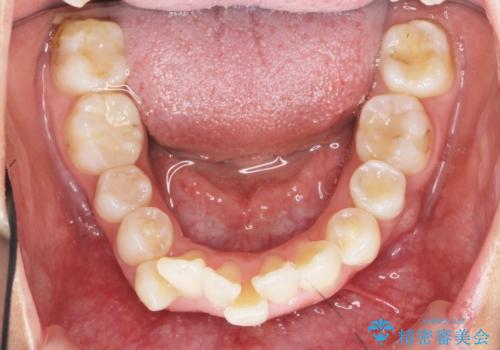 がたつきと出っ歯 ワイヤー矯正での歯並び改善の治療前