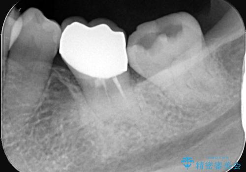 銀歯が取れた 〈セラミックインレー〉の治療前