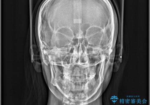 歯のデコボコを治したい! |インビザラインでわずか6ヵ月で矯正完了!の治療後