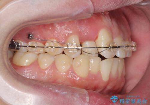 正中過剰埋伏歯で生じた前歯の審美障害 矯正治療での改善の治療中