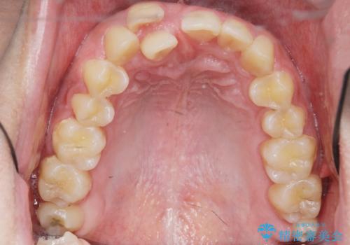 正中過剰埋伏歯で生じた前歯の審美障害 矯正治療での改善の治療前