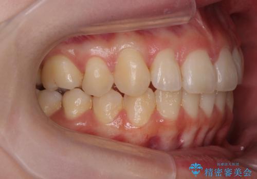 マウスピースで行う出っ歯の改善 後方移動の治療後