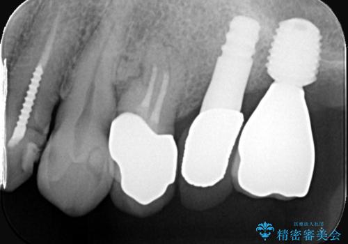 【インプラント】噛んだら痛みがあるの治療後