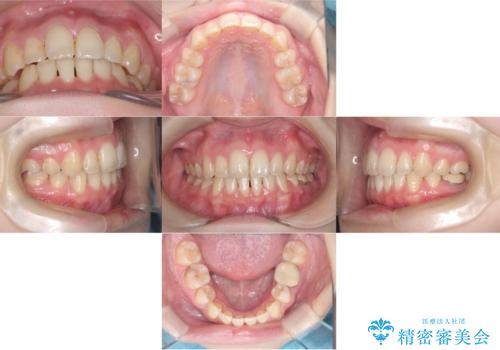 歯のデコボコ|口ボコ|八重歯が気になる!|ワイヤー矯正の治療後