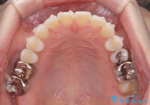 抜歯をせず前歯の角度を改善するマウスピース矯正治療の治療中