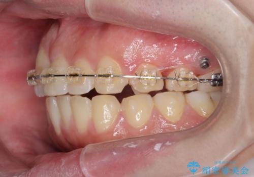 正中過剰埋伏歯で生じた前歯の審美障害 矯正治療での改善の治療中