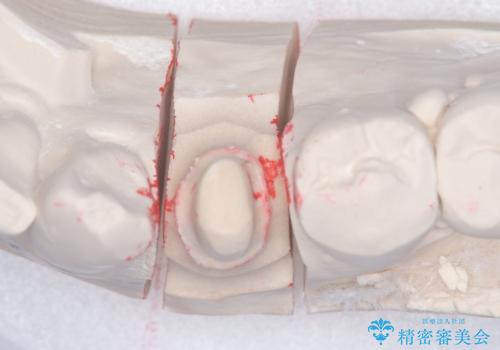 【セラミッククラウン】知覚過敏をどうにかしてほしいの治療中