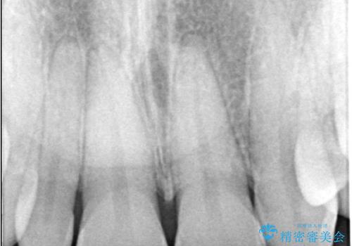 前歯の見た目が気になる!|矮小歯をオールセラミッククラウンで綺麗な形に!|審美回復の治療前