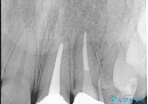 前歯が痛い!|歯の色が気になる!|精密根管治療後、オールセラミッククラウンで審美修復の治療後