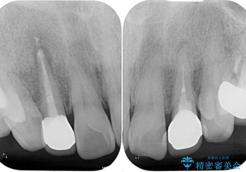 前歯の色味を治したい オールセラミッククラウンの治療後