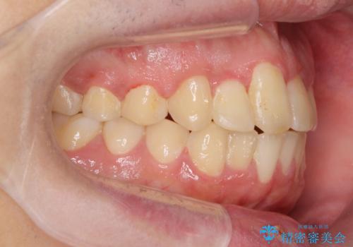 正中過剰埋伏歯で生じた前歯の審美障害 矯正治療での改善の治療後