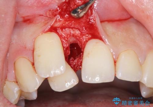 正中過剰埋伏歯で生じた前歯の審美障害 矯正治療での改善の治療前