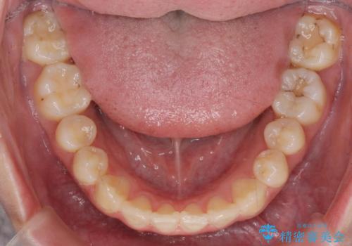 マウスピースで行う出っ歯の改善 後方移動の治療後