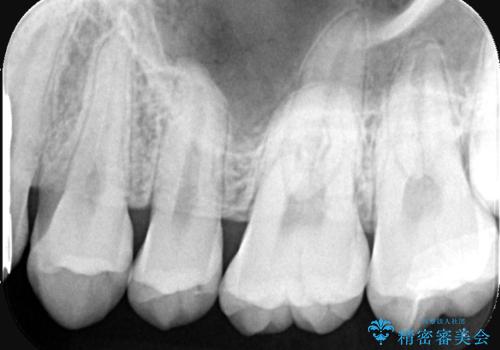 【セラミックインレー】歯科検診で虫歯が見つかったの治療後