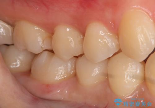 奥歯の虫歯を直したい セラミックインレーの治療後