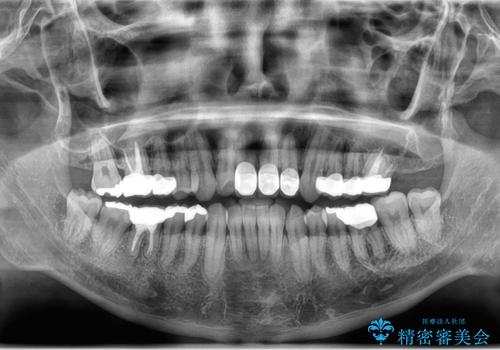 矯正と虫歯のセラミック治療 総合歯科治療の実践の治療後