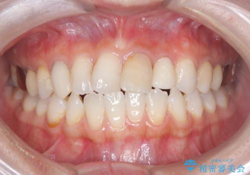 【セラミッククラウン】歯の根元が欠けた、歯が揺れている気がするの症例 治療後