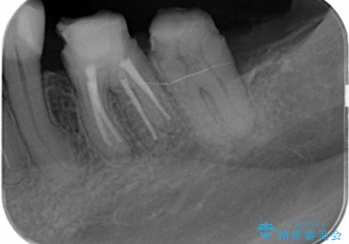 銀歯の除去 長期的な未来を見据えた虫歯治療の治療中
