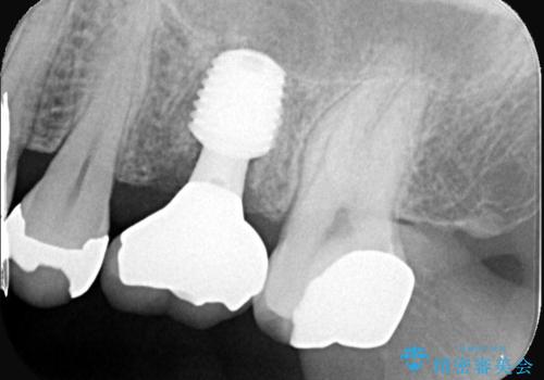 顕微鏡で確認した歯の破折。抜歯即時インプラントで治療の症例 治療後