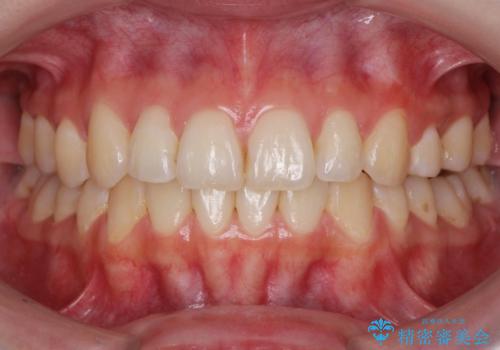 マウスピースで行う出っ歯の改善 後方移動の症例 治療後