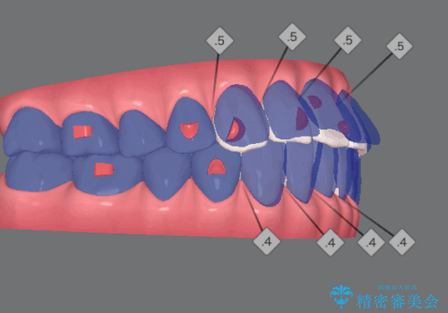 抜歯をせず前歯の角度を改善するマウスピース矯正治療
