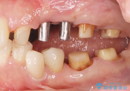 銀歯の除去 長期的な未来を見据えた虫歯治療の治療中