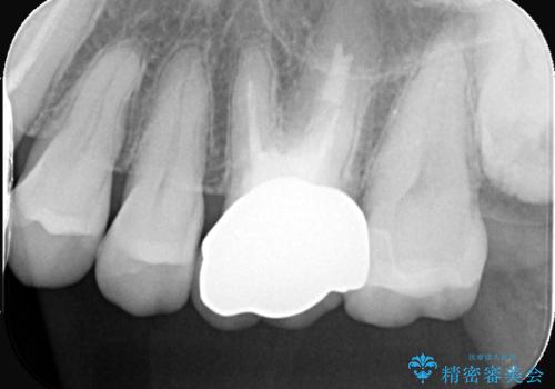 【セラミックインレー】口の中から金属を無くしたいの治療後