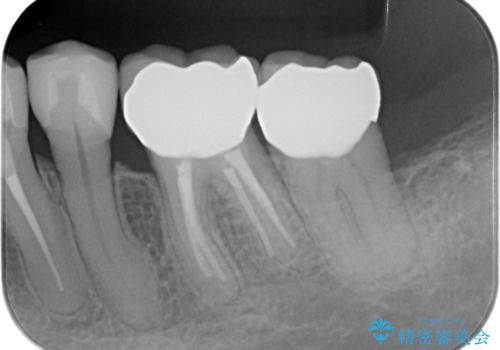 銀歯の除去 長期的な未来を見据えた虫歯治療の治療後