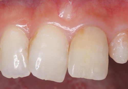 【セラミッククラウン】歯の根元が欠けた、歯が揺れている気がするの治療中