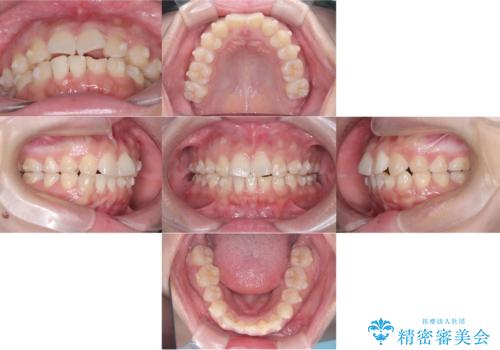歯のデコボコを治したい! |インビザラインでわずか6ヵ月で矯正完了!の治療中