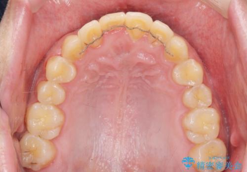 正中過剰埋伏歯で生じた前歯の審美障害 矯正治療での改善の治療後