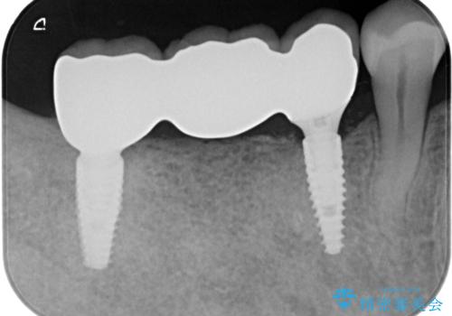 失った奥歯をインプラントで機能回復の治療後