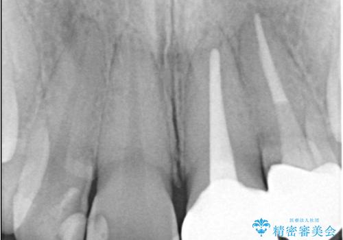 前歯が痛い!|歯の色が気になる!|精密根管治療後、オールセラミッククラウンで審美修復の治療後