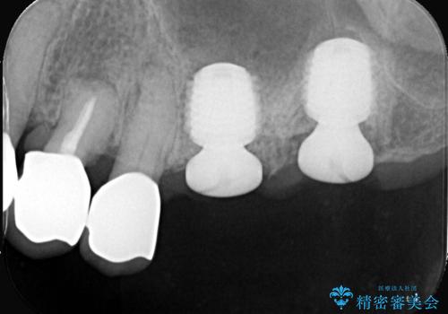 難症例の奥歯も3ヶ月で機能回復!抜歯即時インプラントでスピード解決の治療中