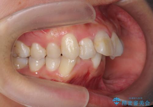 がたつきと出っ歯 ワイヤー矯正での歯並び改善の治療前